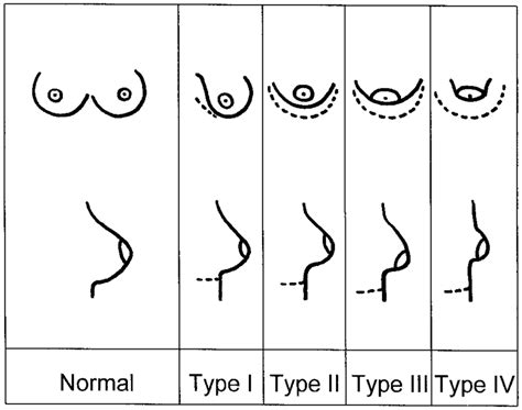 cone shaped tits|Tubular Breast Before and After Photos